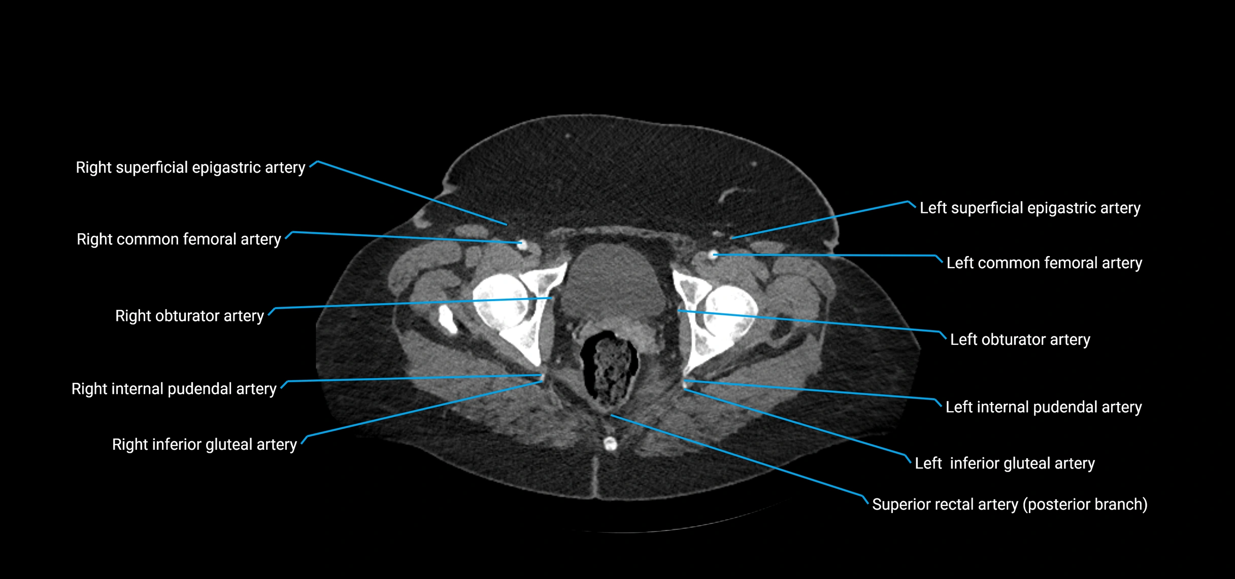 CTA abdomen axial cross sectional anatomy labelled image_247 (2).webp